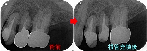 根管治療で使用する綿栓（わた） - EE DENTAL_Blog